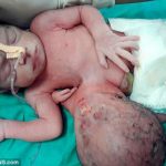 Meet baby born with two heads and three hands (Photo)