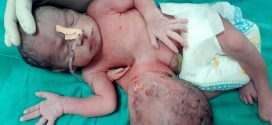 Meet baby born with two heads and three hands (Photo)