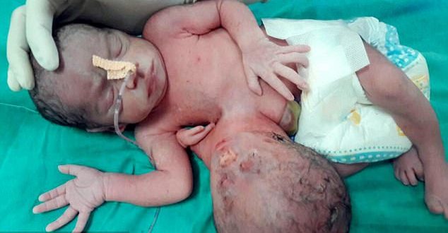 Meet baby born with two heads and three hands “Photo”