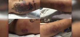 31-year-old man dies after ignoring new tattoos warnings