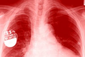 FDA: Pacemakers vulnerable to hacks