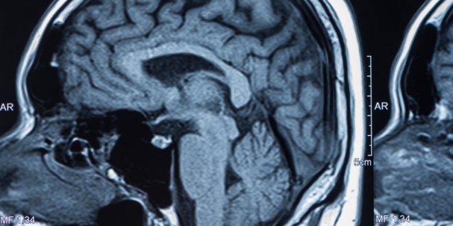 Scientists Restore Consciousness in Man After 15 Years in a Vegetative State