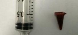 Toy traffic cone found in man's lung after 40 years (Photo)