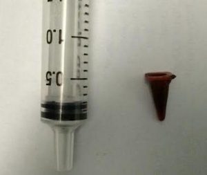 Toy traffic cone found in man's lung after 40 years (Photo)