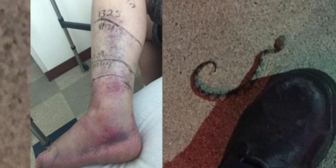 Woman bitten three times by copperhead snake at restaurant