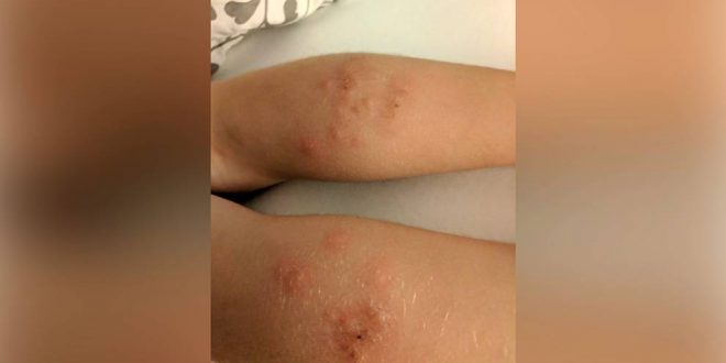 B.C. Family bitten by bed bugs on British Airways flight (Photo)
