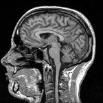Multiple Sclerosis Risk in Children Revealed with MRI Brain Scans, Study Finds