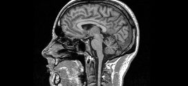 Multiple Sclerosis Risk in Children Revealed with MRI Brain Scans, Study Finds