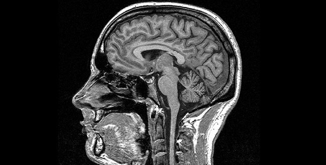 MRIs may help identify MS risks, Finds new research