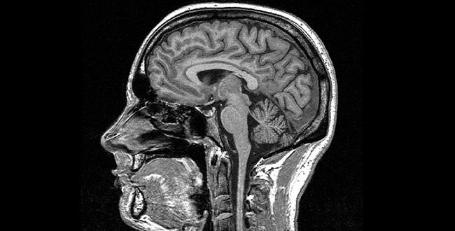 Multiple Sclerosis Risk in Children Revealed with MRI Brain Scans, Study Finds