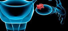 Ovarian cancer starts 6.5 years before it turns deadly, Says New Study