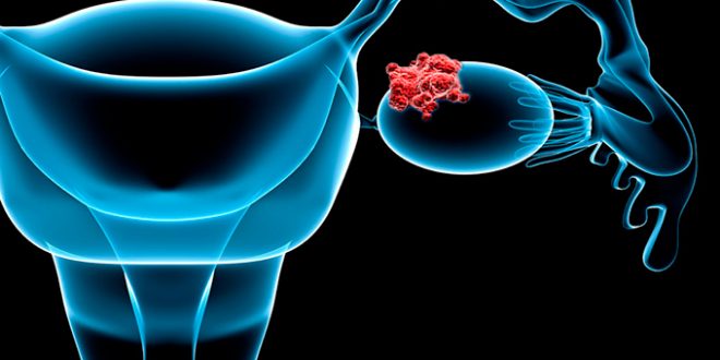 Ovarian cancer starts 6.5 years before it turns deadly, Says New Study