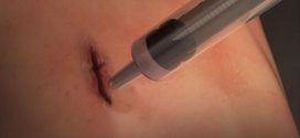 Researchers develop surgical super glue that seals cuts in seconds
