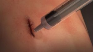 Researchers develop surgical super glue that seals cuts in seconds