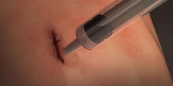 Researchers develop surgical super glue that seals cuts in seconds