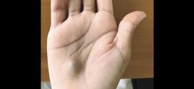 Canada: Guy finds bulging lump on his hand after dentist trip