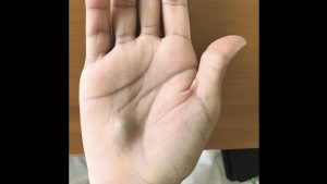 Canada: Guy finds bulging lump on his hand after dentist trip