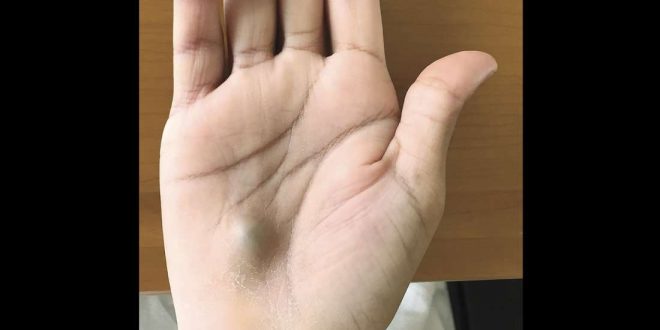 Guy finds bulging lump on his hand after dentist trip